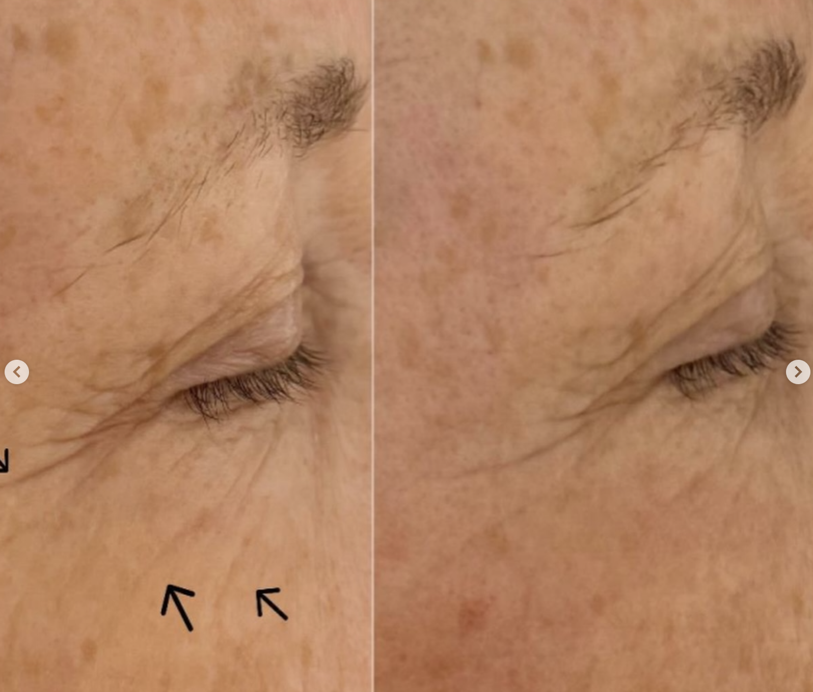 Kenz Beauty client skin result 3, before and after treatment