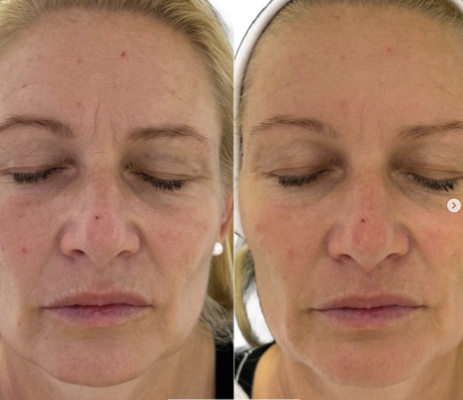 Kenz Beauty client skin result 1, before and after treatment